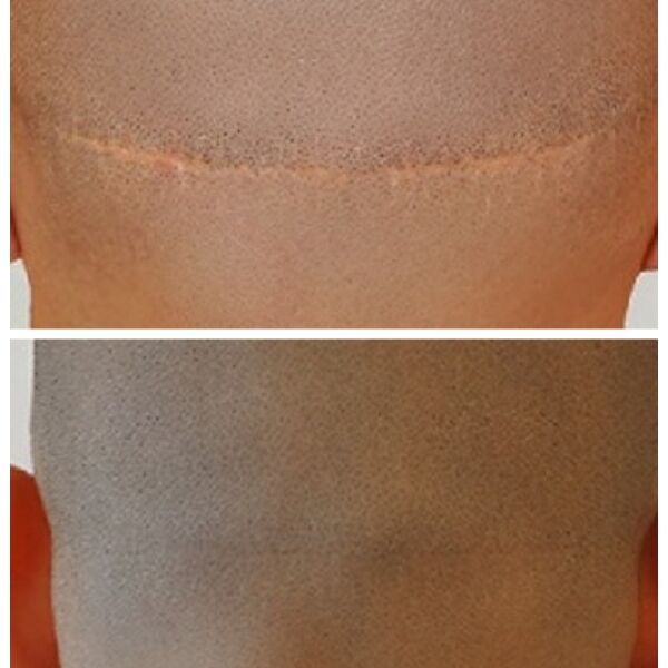 Micropigmentation Before & After
