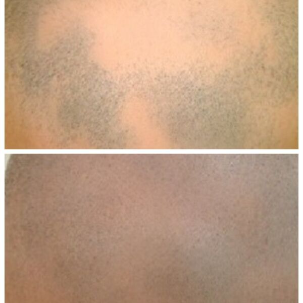 Micropigmentation Before & After