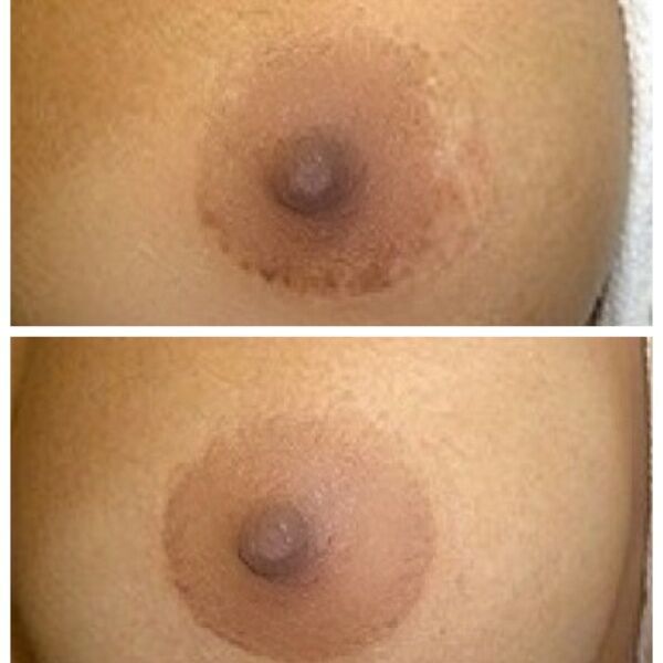 Micropigmentation Before & After